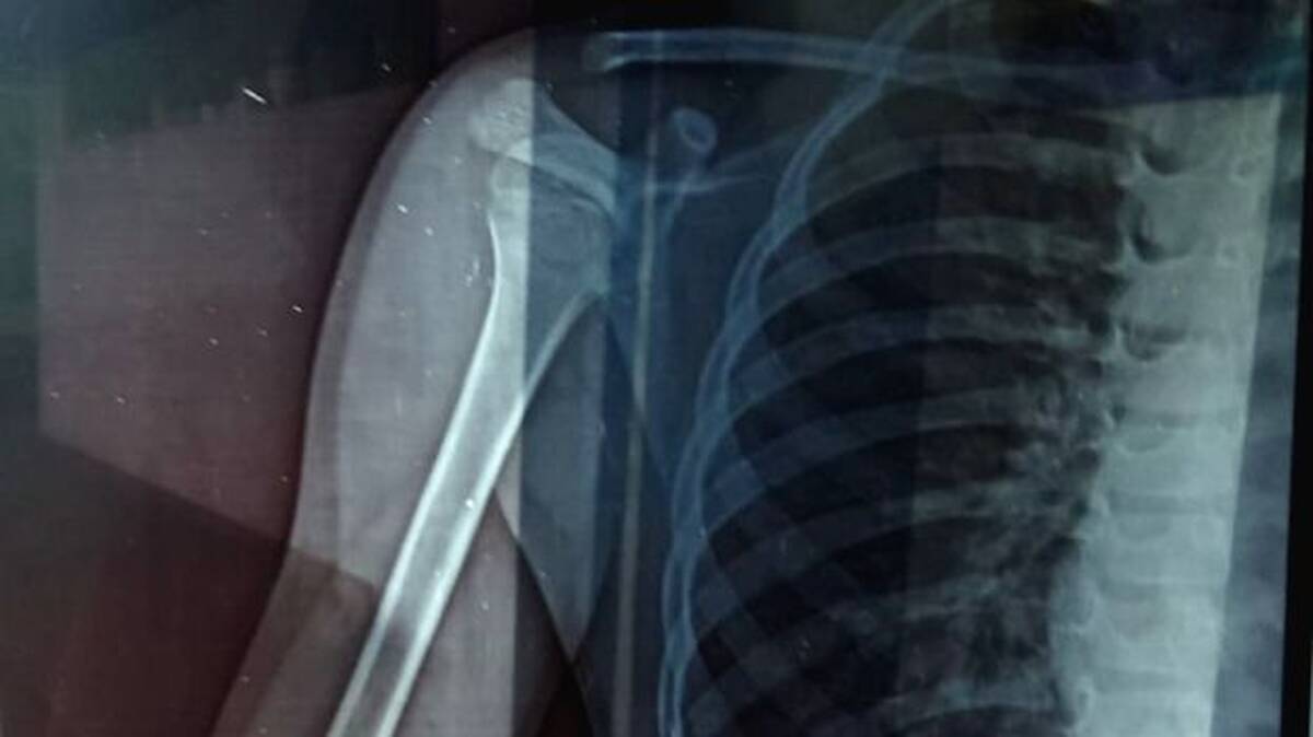 x-ray