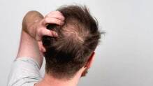 hair-loss