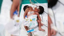 disha-baby-born-with-two-heads-rare-medical-condition